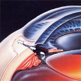 glaucoma2