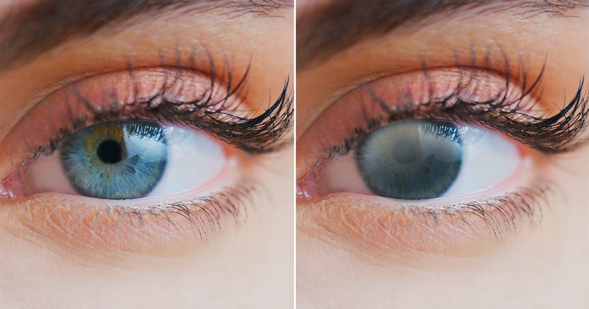 Cataratas: síntomas e intervención